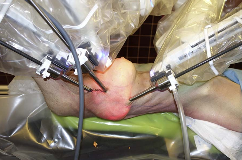 Mastectomy with Whole Breast Reconstruction